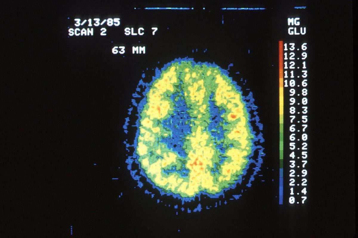 Imagen de un escáner PET cerebral en tonos amarillos, verdes y azules que muestra la actividad metabólica del cerebro