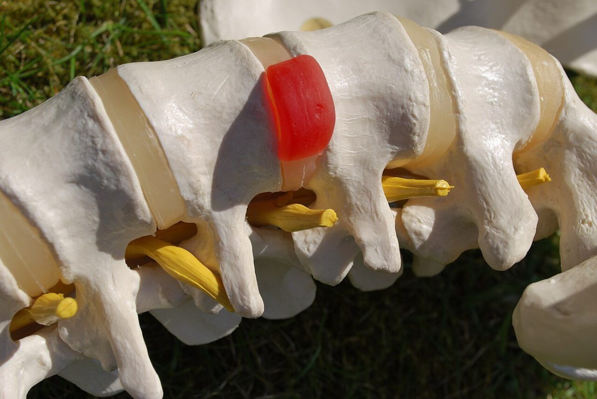 Primer plano de vértebras de un modelo anatómico con un disco intervertebral resaltado en rojo entre los huesos