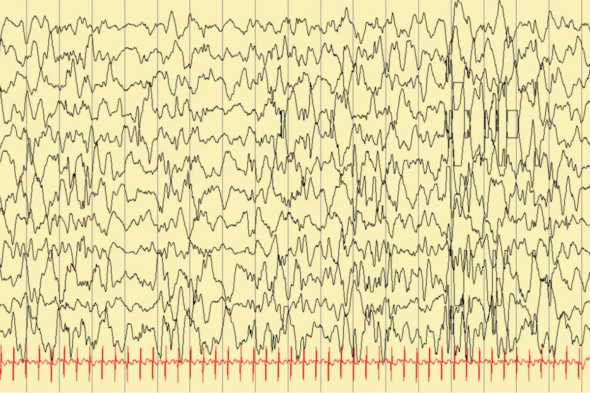 Trazado de electroencefalograma (EEG) mostrando el patrón de hipsarritmia, asociado a los espasmos infantiles