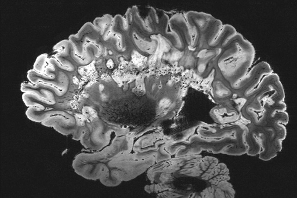 Imagen de resonancia magnética de un cerebro humano en corte sagital, mostrando la corteza cerebral y el cerebelo