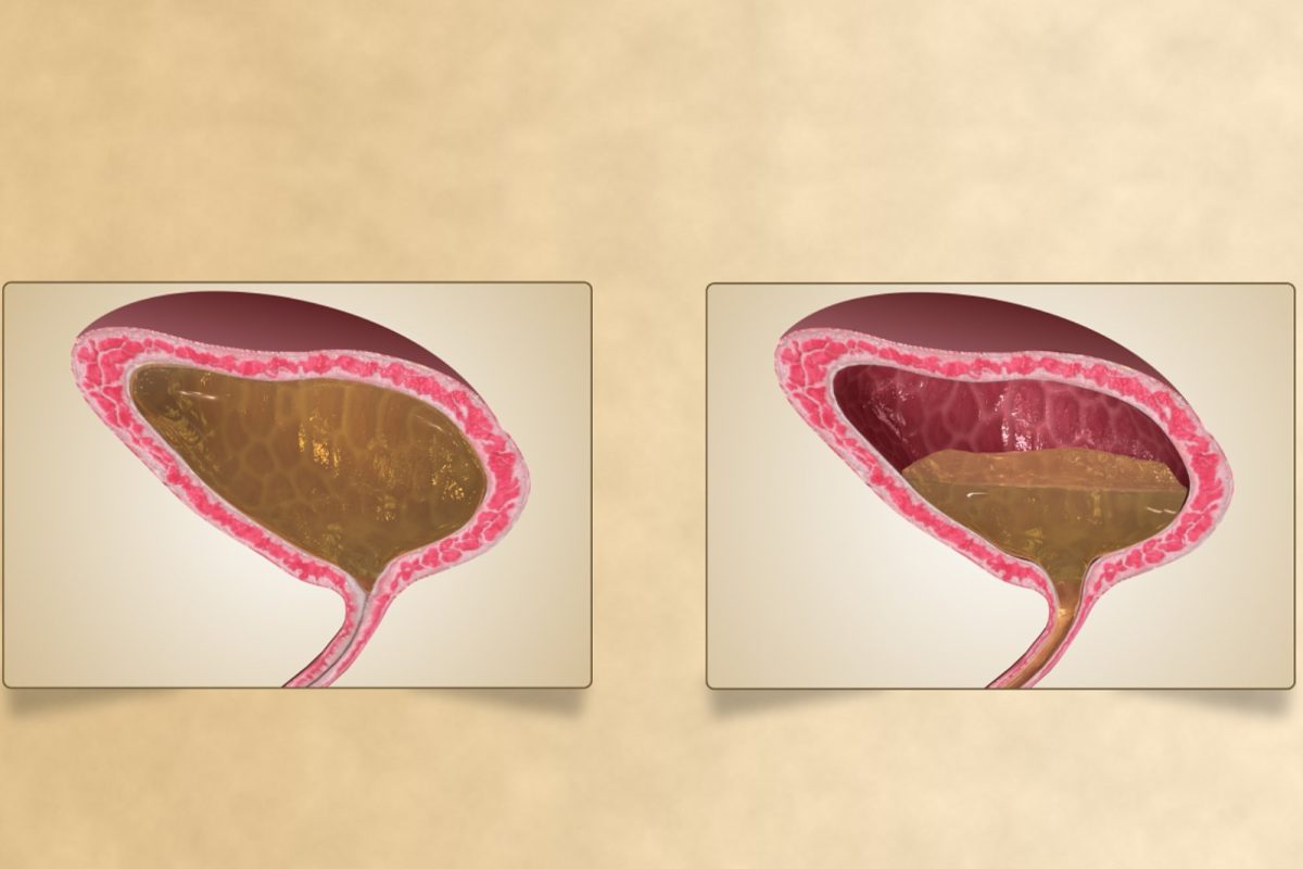 Animación médica en 3D que compara una vejiga urinaria normal con una vejiga hiperactiva.