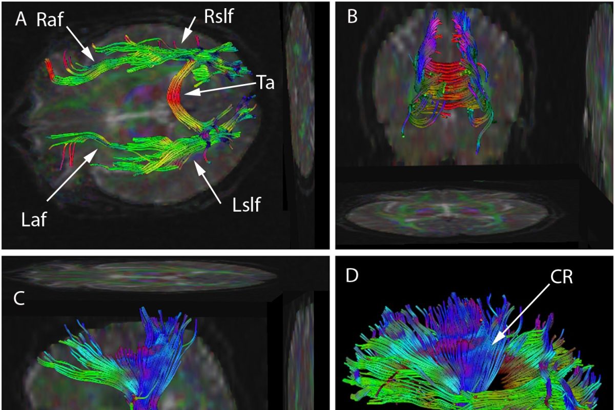 Imágenes de resonancia magnética con tractografía por tensor de difusión (DTI) que muestran los haces de fibras de sustancia blanca del cerebro humano representados en colores según su orientación, en distintos planos.