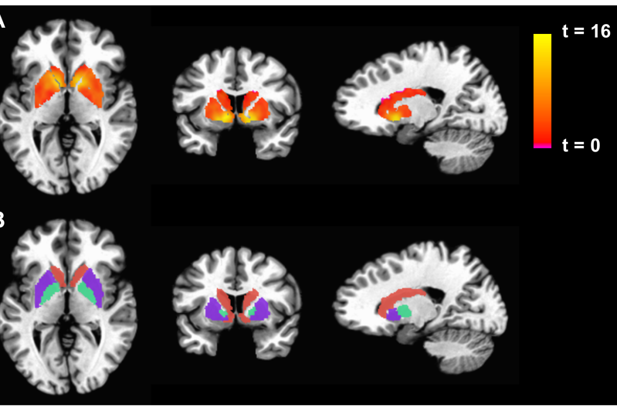 Cortes de resonancia magnetica funcional del cerebro humano con areas de activacion resaltadas en color
