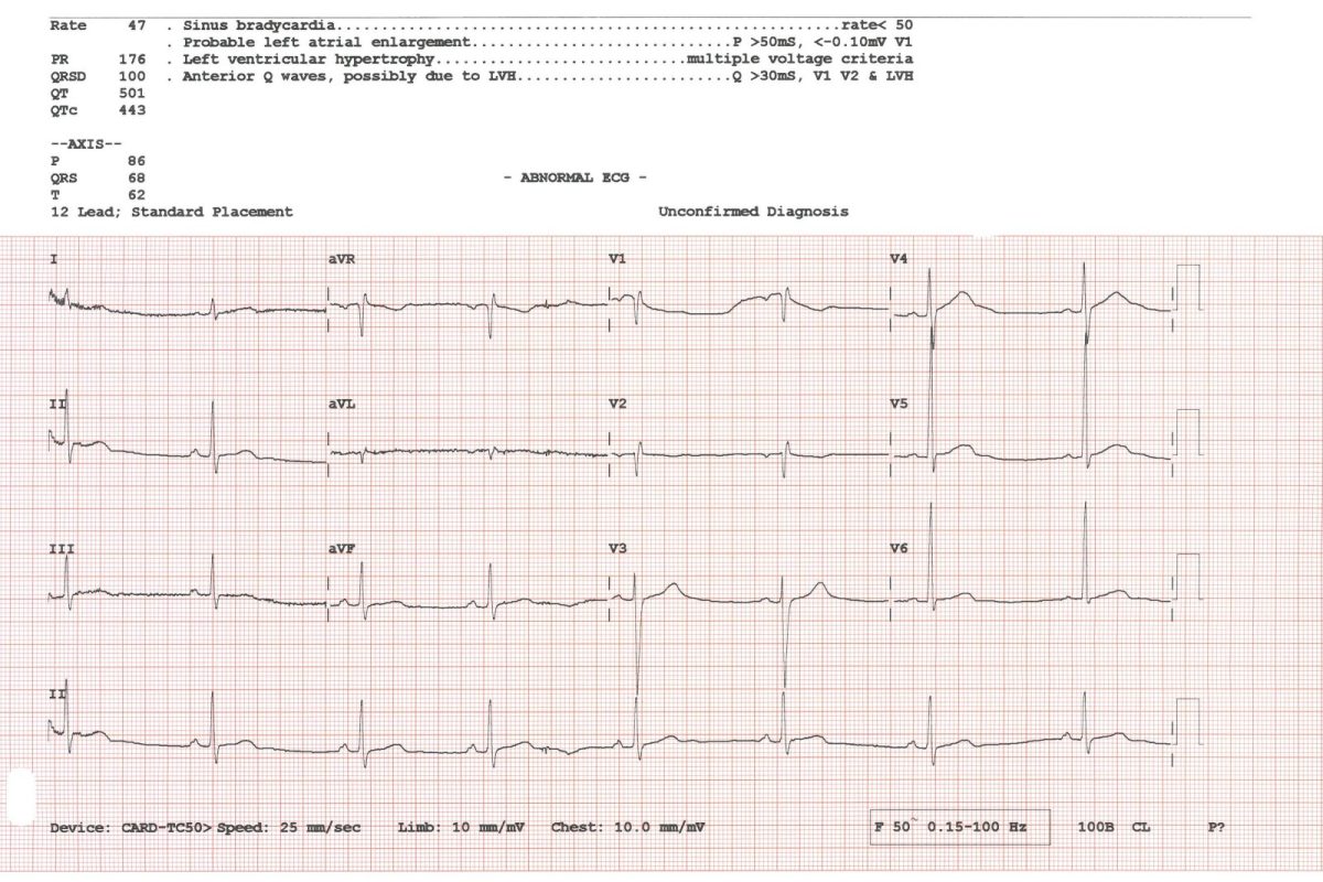 Trazado de un electrocardiograma de 12 derivaciones